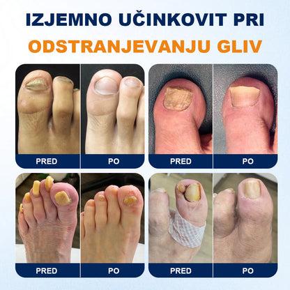 CleraNaure® sprej za lajšanje glivičnih okužb nohtov