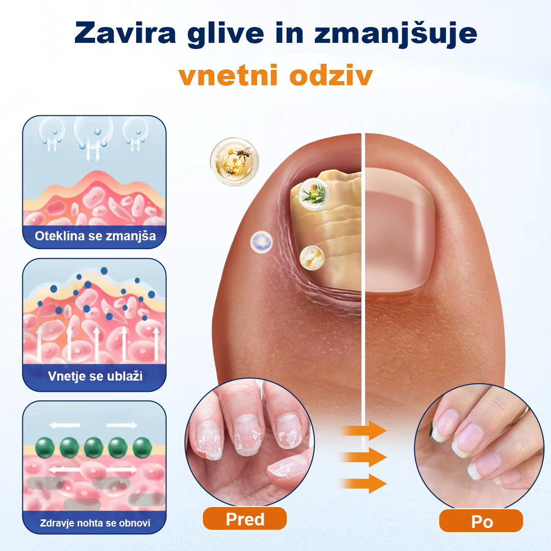 CleraNaure® sprej za lajšanje glivičnih okužb nohtov