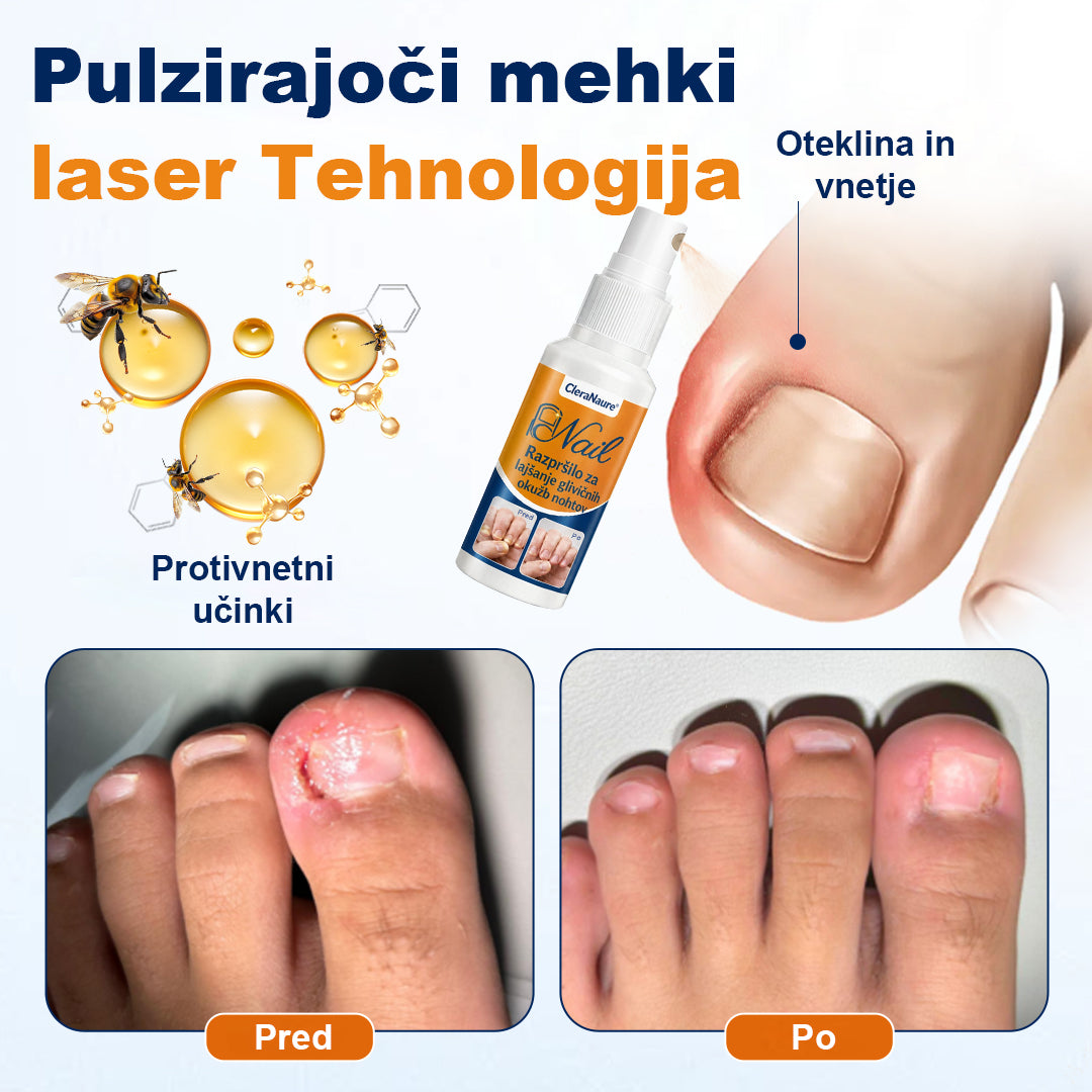 CleraNaure® sprej za lajšanje glivičnih okužb nohtov