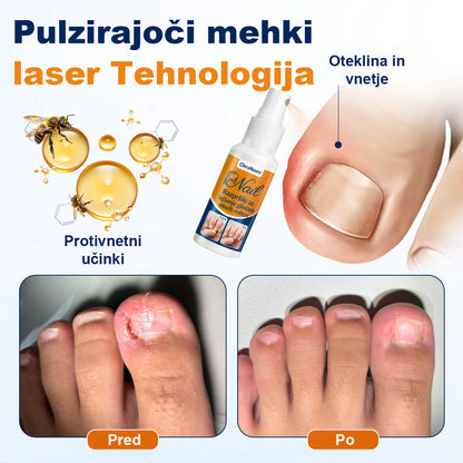CleraNaure® sprej za lajšanje glivičnih okužb nohtov