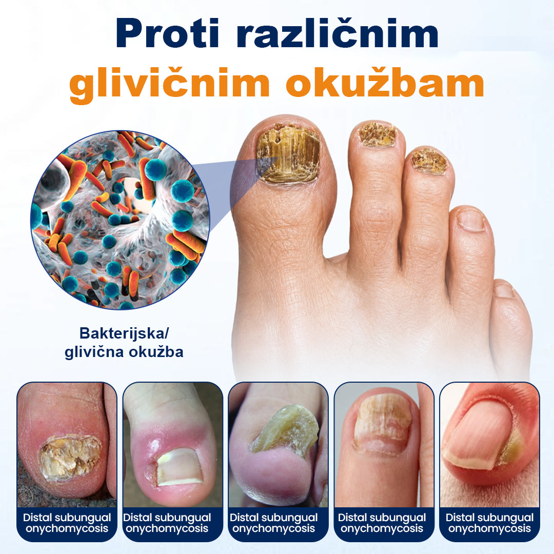 CleraNaure® sprej za lajšanje glivičnih okužb nohtov