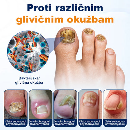 CleraNaure® sprej za lajšanje glivičnih okužb nohtov