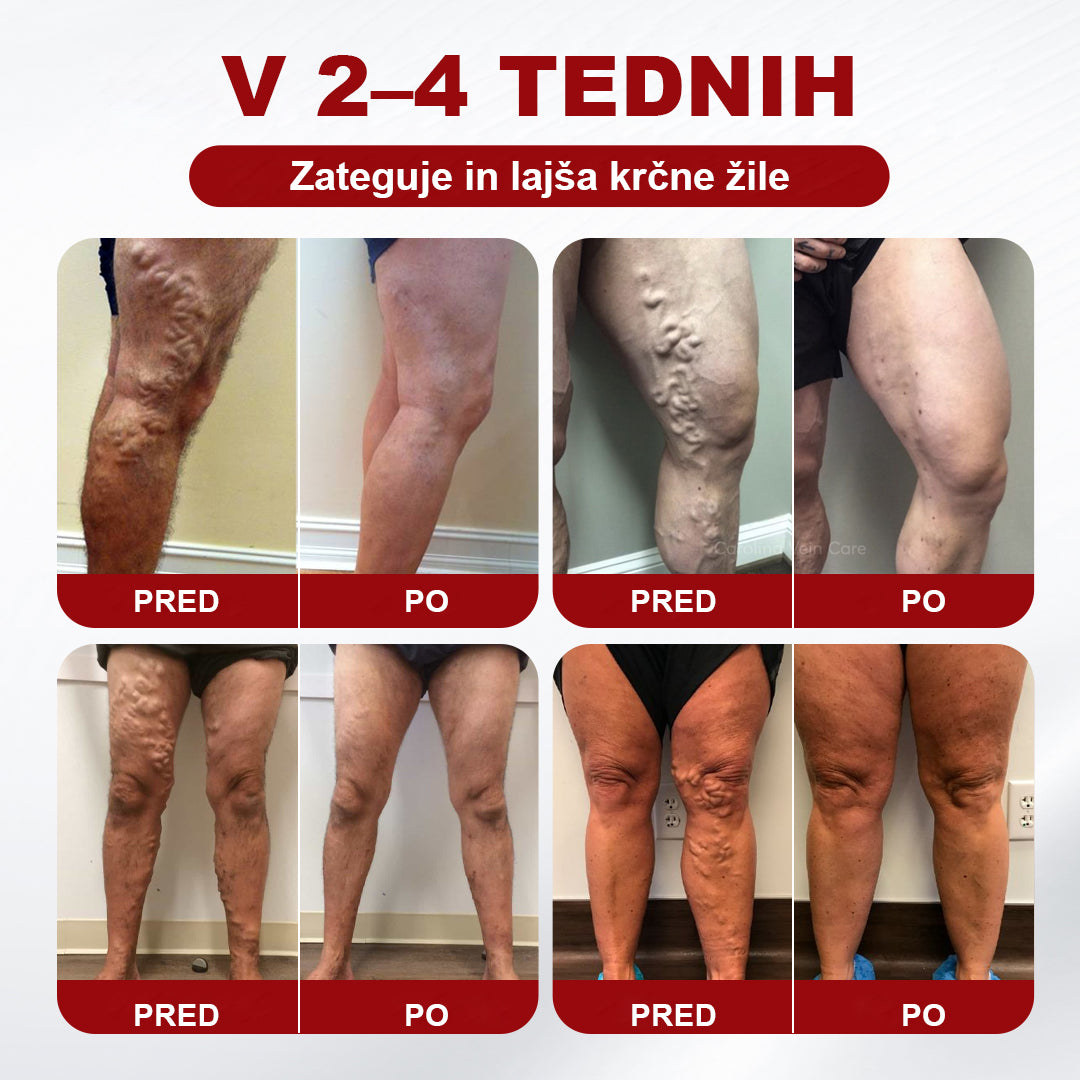 CleraNaure® krema za krčne žile