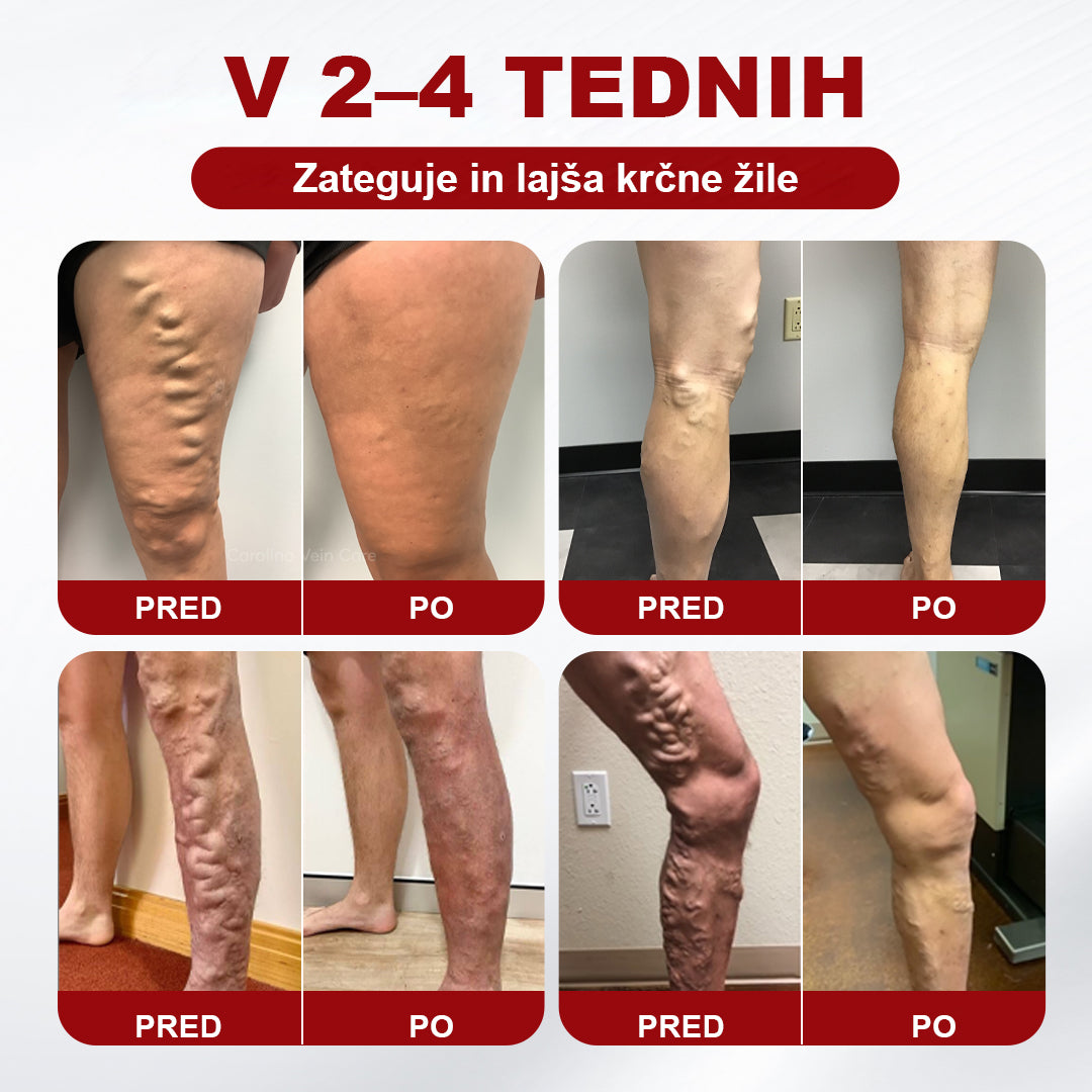 CleraNaure® krema za krčne žile